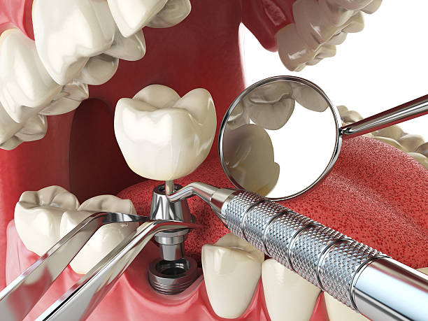 Best Emergency Treatment for Oral Infections in San Luis Obispo, CA